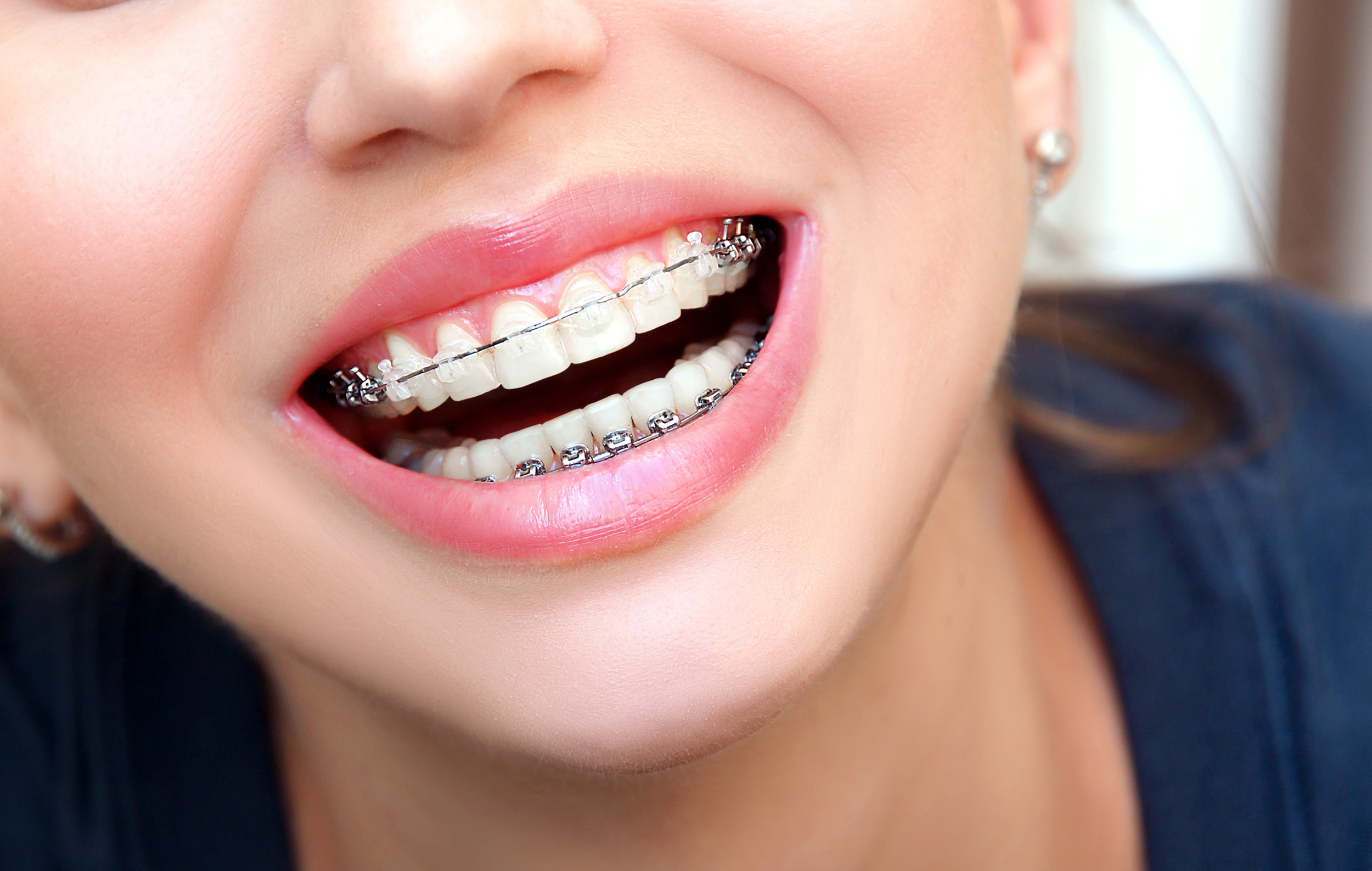 Orthodontic Brace Options The London Orthodontic Group